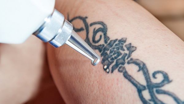 Laser Tattoo Removal In Bangalore
